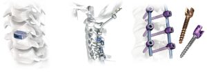 Імпланти для остеосинтезу переломів хребта