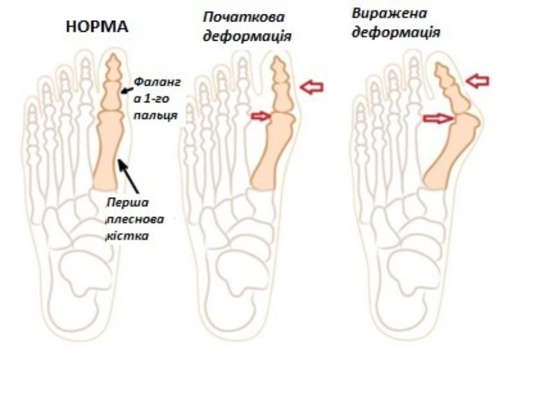 Захворювання стопи халлюкс вальгус (hallux valgus) або вальгусна деформація, в народі «кісточка, шишка» першого пальця стопи