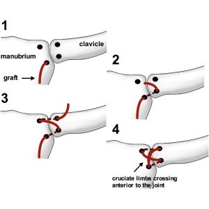 Відкрите вправлення вивиху стернального кінця ключиці, пластика зв'язок стернально-ключичного суглоба сухожилком m.palmaris longus зліва.