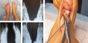 Вальгусна деформація першого пальця стопи (Нallux valgus) – це деформуюче захворювання, яке характеризується прогресивним перебігом, при якому змінюється його положення по відношенню до анатомічної вісі стопи та інших пальців, Дане захворювання – є однією з найпоширеніших деформацій стопи. Вальгусна деформація призводить до запалення в ділянці суглобової сумки та загострення больового синдрому по внутрішній поверхні великого пальця, що призводить до порушення ходьби. Найчастіше зустрічається серед жінок. Причиною виникнення вальгусної деформації першого пальця стопи є: Вроджена слабкість сполучної тканини Гормональні порушення Генетична схильність Довготривале носіння тісного модельного взуття Взуття на високих підборах та з вузьким носком Невірно підібране взуття Лікування Найбільш ефективним методом лікування захворювання – є хірургічне втручання. Виконується ряд оперативних методик: на м'яких тканинах (операція Мак-Брайда) та на кістках (SCARF, Chevron, Akin, Hohmann, Kramer, Mau, Wilson, проксимальні остеотомії), артродези кісток стопи та комбінації хірургічних втручань. Післяопераційний період В післяопераційному періоду хворий активізується на наступний день після операції в спеціальному взутті – туфлі Барука. В ортопедичному взутті необхідно провести від 4 до 8 тижнів, в залежності від проведеного оперативного втручання. Стаціонарне лікування – 3-4 дні. Зняття швів через 14 днів. До 6 місяців не бажано носити взуття на підборах більше 3-4 см. Термін перебування на лікарняному листі – 1,5-2 місяці. Клінічний приклад Хвора звернулась на консультацію зі скаргами на біль в стопі після фізичного навантаження та ходьби на високих підборах. Після клініко-інструментального обстеження виконано оперативне втручання: SCARF остеотомія на лівій стопі та Шеврон остеотомія на правій стопі. На рис представлено фото та рентгенограми до оперативного втручання, під час проведення операції та зовнішній вигляд стоп через 1 рік після операції.