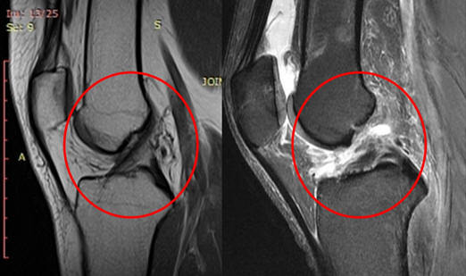 Пошкодження передньої хрестоподібної зв'язки колінного суглоба