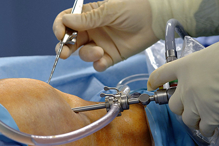 Артроскопія (ендоскопія) - ефективний малоінвазивний (малотравматичний) спосіб діагностики і лікування хвороб суглобів за допомогою артроскопа - оптичного пристрою і набору мініатюрних інструментів, що дозволяють проводити маніпуляції при мінімальному розрізі тканин. Артроскопія є «золотим стандартом» лікування травм і захворювань колінного суглоба у всьому світі.