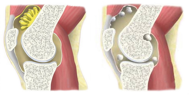 Хондроматоз колінного суглоба
