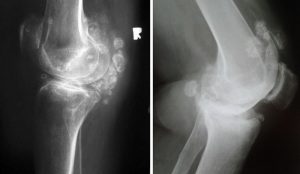Хондроматоз колінного суглоба (синовіальний остеохондроматоз, хвороба Henderson-Jones, «суглобові миші») – хронічний патологічний процес, при якому синовіальна оболонка суглоба частково зазнає змін, поступово перетворюючись на хрящ.